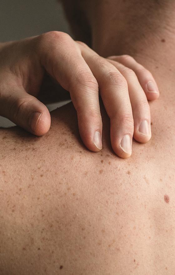 Psoriasis